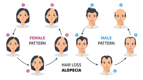 Hair loss stages, androgenetic alopecia male and female pattern. Steps ...