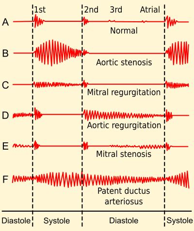 Systolic heart murmur - Wikipedia