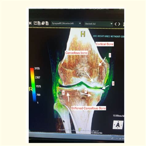 Order of arthritis in the knee joint from the concave side of the joint ...