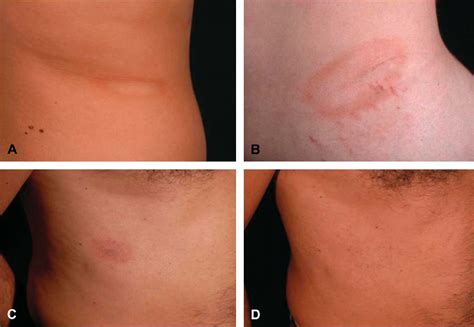 Figure 1 from Annular lichenoid dermatitis of youth ... and beyond: a ...