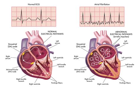 Atrial flutter vs fibrillation - tipname