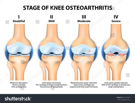 46,755 Knee Anatomy Images, Stock Photos & Vectors | Shutterstock