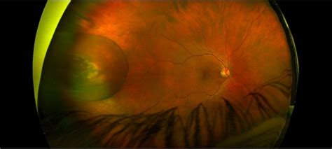 Pars Plana Cyst Mimicking a Retinal Detachment or Retinoschisis ...