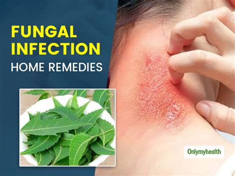 Fungal Skin Infection Bothering You? Here Are 5 Home Remedies To Get ...