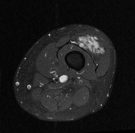 Hemangioma Mri