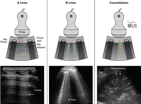 Lung Ultrasound: The Essentials | Radiology: Cardiothoracic Imaging