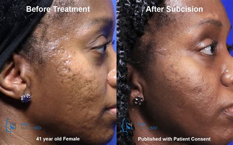 Acne Scar Treatment for Black Skin | Los Angeles