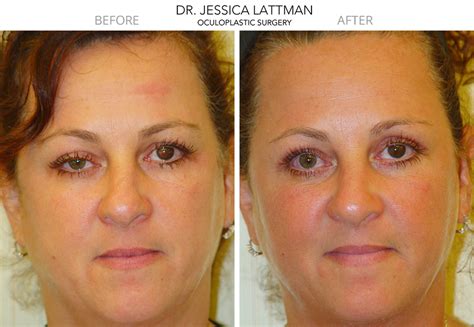 Ptosis Droopy Eyelid Repair Surgeon New York and Manhattan NY