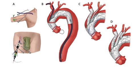 Endovascular Total Arch Repair - Endovascular Today