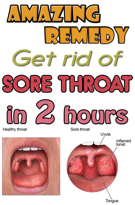 Amazing remedy. Get rid of sore throat in 2 hours - FITNESS SHORTCUT