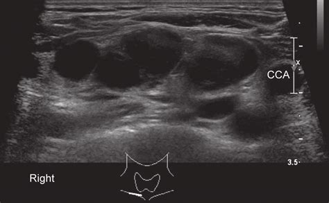 Swollen Lymph Nodes In Neck Ultrasound