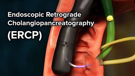 Endoscopic Retrograde Cholangio-Pancreatography (ERCP) - Yashoda Hospital