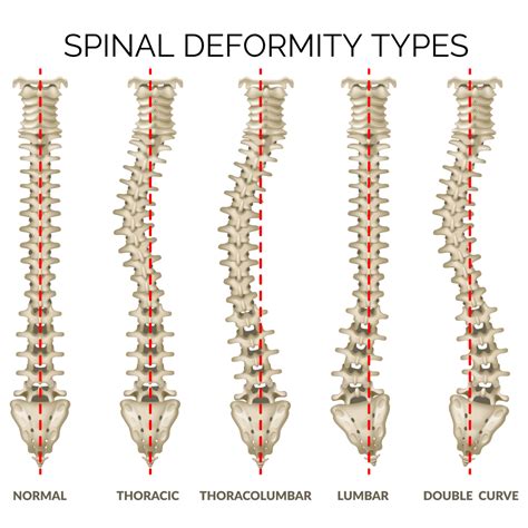 Scoliosis - Hey Clinic