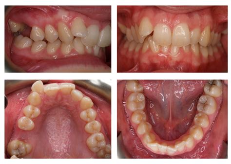 Teeth Before And After Braces Crowding