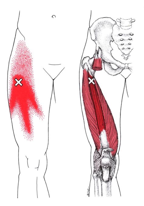 Vastus Intermedius | The Trigger Point & Referred Pain Guide