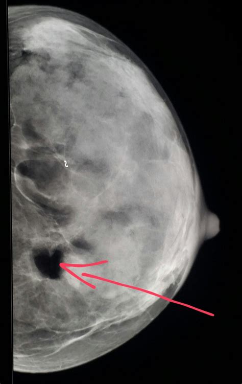 #Breast #mammogram shows a #benign #fatty #mass (#lipoma) surrounded by ...