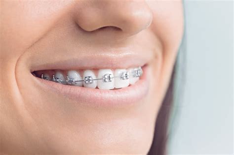 Types of Braces Right For You | Dr. Floreani, O'Toole & Dool Orthodontics