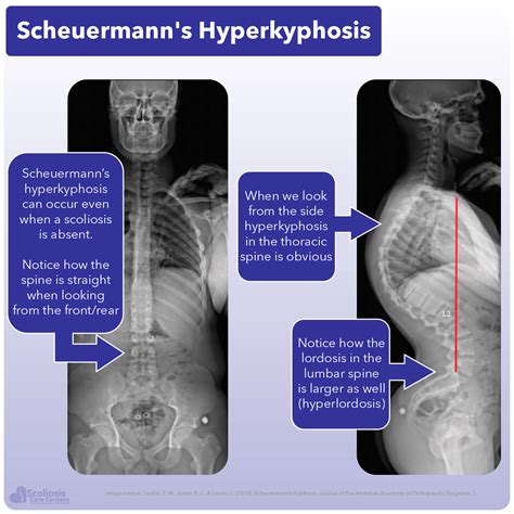 Scheuermann’s Kyphosis Treatments By Our Expert Physicians