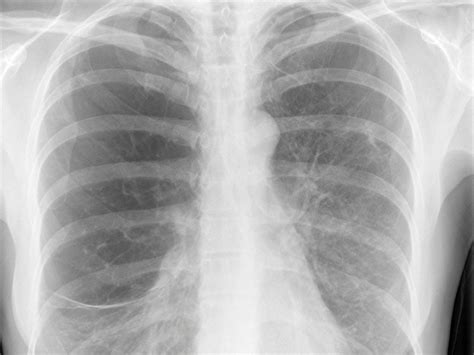 Healthy Lungs Vs Smokers Lungs X Ray