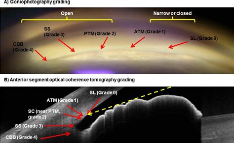 Figure 1 from Remote Grading of the Anterior Chamber Angle Using ...