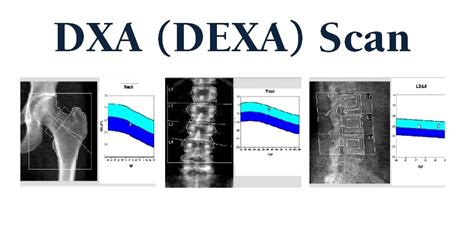 DEXA Scan | Department of Radiology | UC Davis Health