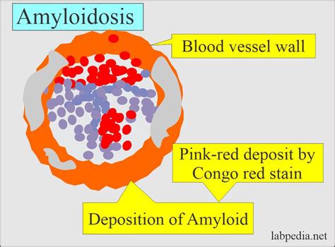 Amyloidosis, Samples, and Diagnosis - Labpedia.net