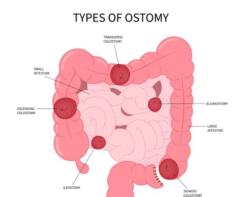 Colostomy & Ileostomy | Colorectal Cancer Alliance