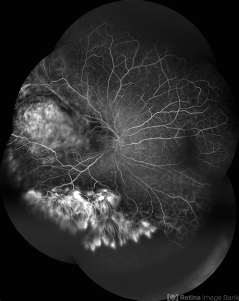 Choroidal Hemangioma - Retina Image Bank