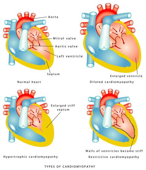 The 5 Different Types of Cardiomyopathy - Pulse Cardiology