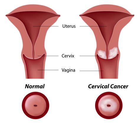 Abnormal Pap Smear - International Women's Clinic