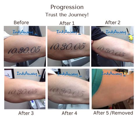 Progression of Tattoo Removal - InkAway Laser Tattoo Removal