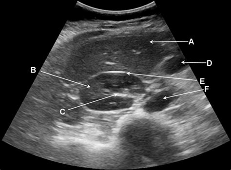 Ultrasound scan of the right upper quadrant of the abdomen, transverse ...