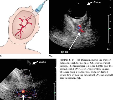 Figure 4 from Advances in transcranial Doppler US: imaging ahead ...