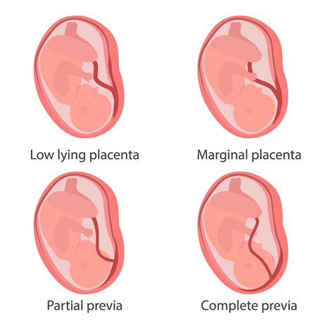 Four types of placenta previa concept illustration 2204021 Vector Art ...