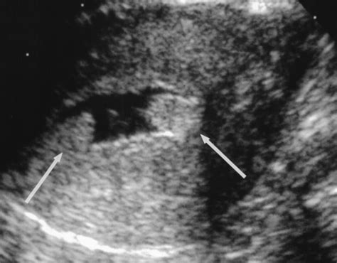 Endometrial Polyps Sonohysterographic Evaluation | AJR