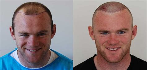 Wayne Rooney Hair Transplant Result - Before and after images, Story