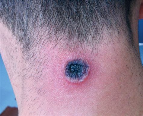 Figure 1 from Cutaneous anthrax on an unexpected area of body ...