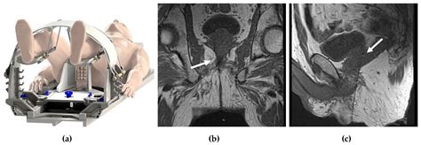 Cancers | Free Full-Text | Real-Time MRI-Guided Prostate Interventions