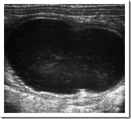 Enteric duplication cysts pediatric - Radiology Imaging