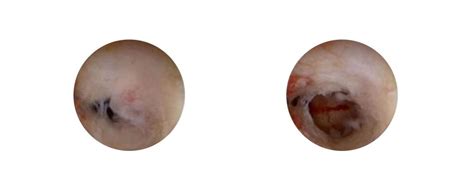 Intrauterine Surgery Adhesion Barriers | FzioMed