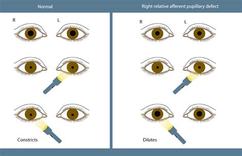 Pupil Gauge Chart