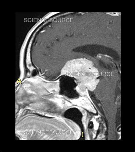 Planum Sphenoidale Meningioma, MRI | Stock Image - Science Source Images