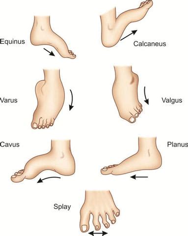 Study extra about Foot deformities – HappyWalk - Lakeview Foot Care