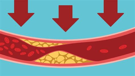 Twice Yearly Injections Halve Bad Cholesterol in Patients With Clogged ...