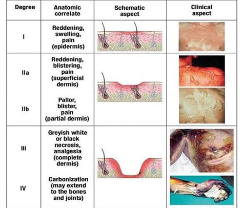 Pin by Jaclyn DeVincentis on FX Reference | Burn injury, Burns nursing ...