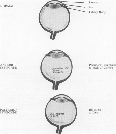 Table 1 from Posterior Impaired _ Anterior Macular Syneohiae ...