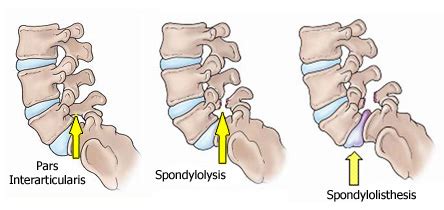 Non-Surgical Options for Spondylolysis and Spondylolisthesis | Georgia ...