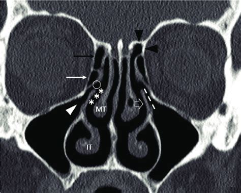 Coronal CT scan showing the components of the ostiomeatal unit: ethmoid ...