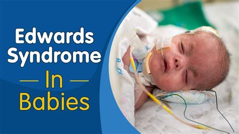 Trisomy 18, Edwards Syndrome Causes, Symptoms, Life, 57% OFF