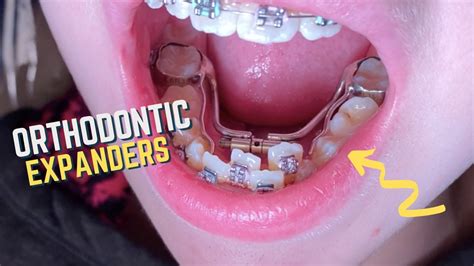 Braces Checkups - 11 year old patient - Upper and Lower Orthodontic ...